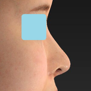 「鼻中隔延長修正＋耳介軟骨移植修正＋鼻尖形成修正＋小鼻縮小＋α法修正＋鼻柱下降＋猫手術＋真皮脂肪移植（鼻尖）」　新宿ラクル美容外科クリニック　２０代女性　手術後２ヶ月目　７月６日