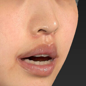 新宿ラクル美容外科クリニック　山本厚志　「人中短縮術（リップリフト）＋口角挙上（スマイルリップ）」　手術後２ヶ月目　４月１９日