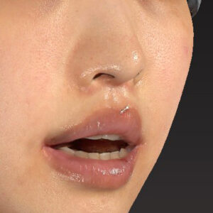新宿ラクル美容外科クリニック　山本厚志　「人中短縮術（リップリフト）＋口角挙上（スマイルリップ）」　手術後３ヶ月目　４月１９日