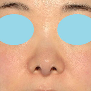 「鼻孔縁下降術」　新宿ラクル美容外科クリニック　山本厚志　３０代女性　手術前　５月１８日
