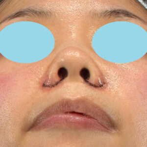 新宿ラクル美容外科クリニック　山本厚志　「貴族手術（鼻翼基部プロテーゼ）＋ 小鼻縮小+α法」　手術直後　５月１日