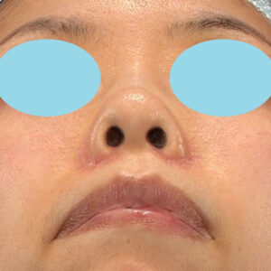 新宿ラクル美容外科クリニック　山本厚志　「貴族手術（鼻翼基部プロテーゼ）＋ 小鼻縮小+α法」　手術後１ヶ月目　５月１日