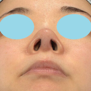 「鼻孔縁下降術」　新宿ラクル美容外科クリニック　山本厚志　３０代女性　手術後１ヶ月目　５月１８日