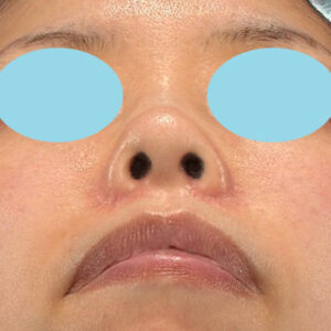新宿ラクル美容外科クリニック　山本厚志　「貴族手術（鼻翼基部プロテーゼ）＋ 小鼻縮小+α法」　手術後２ヶ月目　５月１日
