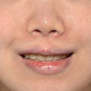 新宿ラクル美容外科クリニック　山本厚志　「貴族手術（鼻翼基部プロテーゼ）」　手術後１ヶ月目　５月２２日