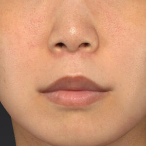 新宿ラクル美容外科クリニック　山本厚志　「人中短縮術（リップリフト）＋口角挙上（スマイルリップ）」　手術後３ヶ月目　７月２１日