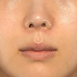 新宿ラクル美容外科クリニック　山本厚志　「貴族手術（鼻翼基部プロテーゼ）」　手術後６ヶ月目　８月５日