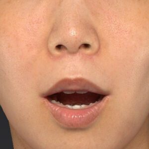 新宿ラクル美容外科クリニック　山本厚志　「人中短縮術（リップリフト）＋口角挙上（スマイルリップ）」　手術後３ヶ月目　７月２１日