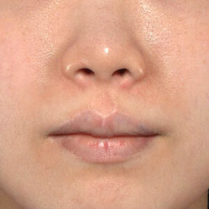 新宿ラクル美容外科クリニック　山本厚志　「貴族手術（鼻翼基部プロテーゼ）」　手術前　７月１１日