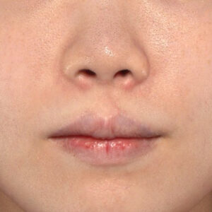 新宿ラクル美容外科クリニック　山本厚志　「貴族手術（鼻翼基部プロテーゼ）」　手術後１ヶ月目　７月１１日