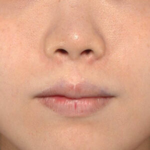 新宿ラクル美容外科クリニック　山本厚志　「貴族手術（鼻翼基部プロテーゼ）」　手術後３ヶ月目　７月１１日