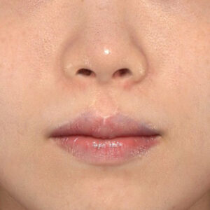 新宿ラクル美容外科クリニック　山本厚志　「貴族手術（鼻翼基部プロテーゼ）」　手術後６ヶ月目　１０月８日