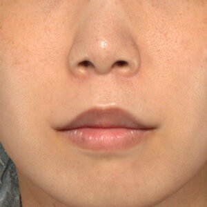新宿ラクル美容外科クリニック　山本厚志　「人中短縮術（リップリフト）＋口角挙上（スマイルリップ）」　手術後６ヶ月目　１０月１日