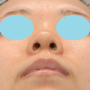 「鼻中隔延長＋耳介軟骨移植＋鼻尖形成＋鼻柱下降＋貴族手術＋真皮脂肪移植（鼻尖）＋鼻プロテーゼ隆鼻術」　新宿ラクル美容外科クリニック　２０代女性　手術前　７月２７日