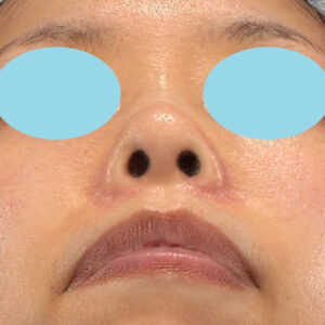 新宿ラクル美容外科クリニック　山本厚志　「貴族手術（鼻翼基部プロテーゼ）＋ 小鼻縮小+α法」　手術後６ヶ月目　７月１８日