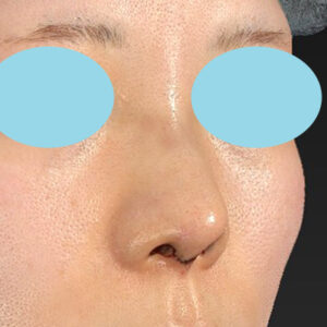 「鼻中隔延長＋耳介軟骨移植＋鼻尖形成＋鼻柱下降＋貴族手術＋真皮脂肪移植（鼻尖）＋鼻プロテーゼ隆鼻術」　新宿ラクル美容外科クリニック　２０代女性　手術直後　７月２７日
