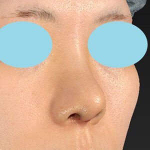 「鼻中隔延長＋耳介軟骨移植＋鼻尖形成＋鼻柱下降＋貴族手術＋真皮脂肪移植（鼻尖）＋鼻プロテーゼ隆鼻術」　新宿ラクル美容外科クリニック　２０代女性　手術後１週間目　７月２７日