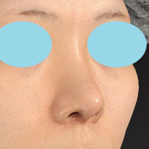 「鼻中隔延長＋耳介軟骨移植＋鼻尖形成＋鼻柱下降＋貴族手術＋真皮脂肪移植（鼻尖）＋鼻プロテーゼ隆鼻術」　新宿ラクル美容外科クリニック　２０代女性　手術後２ヶ月目　７月２７日