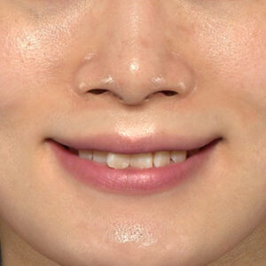 新宿ラクル美容外科クリニック　山本厚志　「貴族手術（鼻翼基部プロテーゼ）」　手術後６ヶ月目　８月２３日