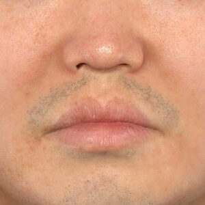 新宿ラクル美容外科クリニック　山本厚志　「貴族手術（鼻翼基部プロテーゼ）」　手術前　８月４日