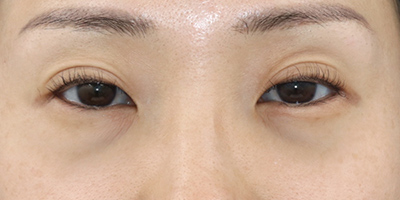Before image