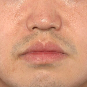 新宿ラクル美容外科クリニック　山本厚志　「貴族手術（鼻翼基部プロテーゼ）」　手術後２ヶ月目　８月４日