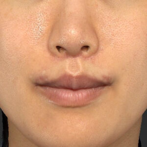 新宿ラクル美容外科クリニック　山本厚志　「人中短縮術（リップリフト）＋口角挙上（スマイルリップ）」　手術後２ヶ月目　８月２０日