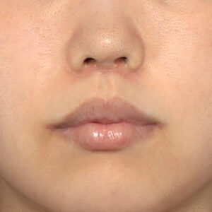 新宿ラクル美容外科クリニック　山本厚志　「人中短縮術（リップリフト）＋口角挙上（スマイルリップ）」　手術後３ヶ月目　８月２８日
