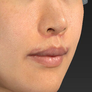 新宿ラクル美容外科クリニック　山本厚志　「人中短縮術（リップリフト）＋口角挙上（スマイルリップ）」　手術後１ヶ月目　８月２０日