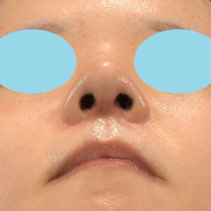 新宿ラクル美容外科クリニック　山本厚志　「鼻中隔延長(鼻中隔軟骨)＋耳介軟骨移植＋鼻尖形成＋真皮脂肪移植（鼻尖）＋小鼻縮小＋α法＋貴族手術＋猫手術」　手術後３ヶ月目　９月１０日