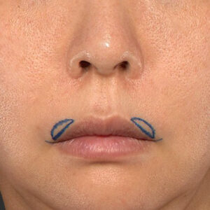 新宿ラクル美容外科クリニック　山本厚志　「人中短縮術（リップリフト）＋口角挙上（スマイルリップ）」　デザイン　９月１８日