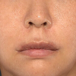 新宿ラクル美容外科クリニック　山本厚志　「人中短縮術（リップリフト）＋口角挙上（スマイルリップ）」　手術後３ヶ月目　９月１８日
