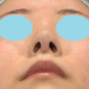 「鼻孔縁下降術」　新宿ラクル美容外科クリニック　山本厚志　３０代女性　手術後１週間目　９月９日
