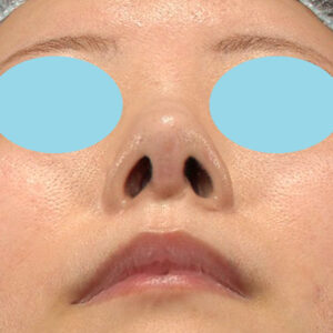 「鼻孔縁下降術」　新宿ラクル美容外科クリニック　山本厚志　３０代女性　手術後１ヶ月目　９月９日