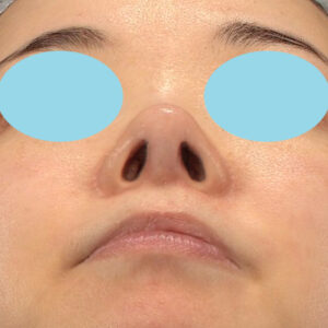 「鼻孔縁下降術」　新宿ラクル美容外科クリニック　山本厚志　３０代女性　手術後６ヶ月目　９月２０日