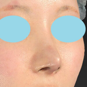 「鼻中隔延長(鼻中隔軟骨)修正＋耳介軟骨移植修正＋鼻尖形成修正＋真皮脂肪移植（鼻尖）＋鼻孔縁下降術(鼻孔縁形成術)」　新宿ラクル美容外科クリニック　２０代女性　手術後２ヶ月目　１０月２８日