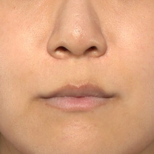 新宿ラクル美容外科クリニック　山本厚志　「人中短縮術（リップリフト）＋口角挙上（スマイルリップ）＋外側人中短縮」　手術前　１０月３１日
