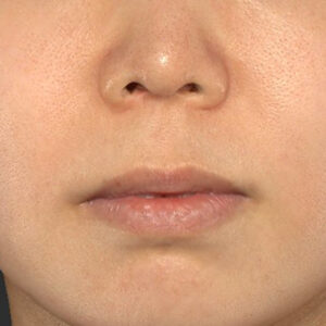 新宿ラクル美容外科クリニック　山本厚志　「人中短縮術（リップリフト）＋口角挙上（スマイルリップ）」　手術前　１０月１２日