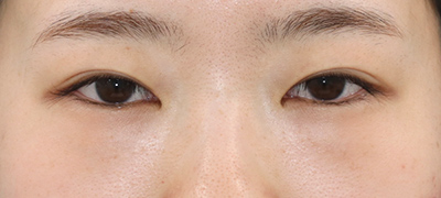 手術前 全切開法二重術+上瞼脂肪取り 新宿ラクル美容外科クリニック 山本厚志 手術前 10月14日