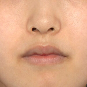 新宿ラクル美容外科クリニック　山本厚志　20代女性の口角挙上（スマイルリフト）手術前・正面閉口時の症例写真　１０月２４日