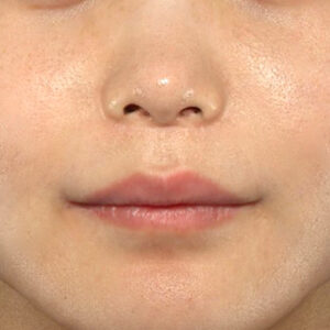新宿ラクル美容外科クリニック　山本厚志　「人中短縮術（リップリフト）」　手術後１２ヶ月目　１０月２日