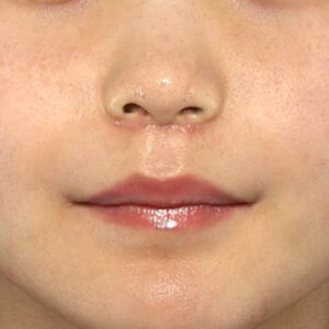 新宿ラクル美容外科クリニック　山本厚志　「人中短縮術（リップリフト）」　手術後１ヶ月目　１０月２日