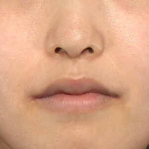 新宿ラクル美容外科クリニック　山本厚志　20代女性の口角挙上（スマイルリフト）手術後１ヶ月目・正面閉口時の症例写真　１０月２４日