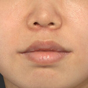 新宿ラクル美容外科クリニック　山本厚志　「人中短縮術（リップリフト）＋口角挙上（スマイルリップ）」　手術後２ヶ月目　１０月１２日