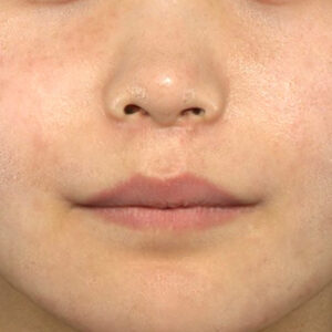 新宿ラクル美容外科クリニック　山本厚志　「人中短縮術（リップリフト）」　手術後２ヶ月目　１０月２日