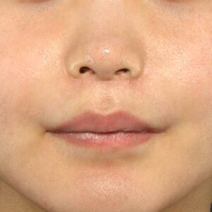 新宿ラクル美容外科クリニック　山本厚志　「人中短縮術（リップリフト）」　手術後６ヶ月目　１０月２日