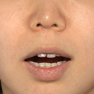 新宿ラクル美容外科クリニック　山本厚志　「人中短縮術（リップリフト）＋口角挙上（スマイルリップ）」　手術前　１０月１２日
