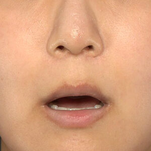 新宿ラクル美容外科クリニック　山本厚志　「人中短縮術（リップリフト）＋口角挙上（スマイルリップ）＋外側人中短縮」　手術前　１０月３１日