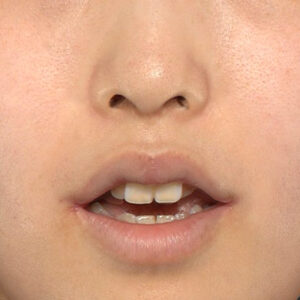 新宿ラクル美容外科クリニック　山本厚志　20代女性の口角挙上（スマイルリフト）手術後１ヶ月目・正面開口時の症例写真　１０月２４日