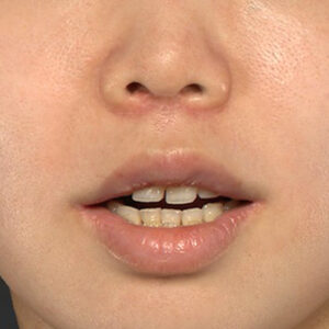 新宿ラクル美容外科クリニック　山本厚志　「人中短縮術（リップリフト）＋口角挙上（スマイルリップ）」　手術後２ヶ月目　１０月１２日